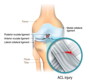 <img src="https://www.wh.com.sg/ForPatientsVisitors/conditionstreatments/PublishingImages/anterior-cruciate-ligament-ACL-injury.jpg" alt="https://www.wh.com.sg/ForPatientsVisitors/conditionstreatments/PublishingImages/anterior-cruciate-ligament-ACL-injury.jpg" width="717" height="669" class="shrinkToFit">